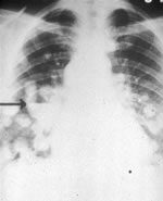 Shëndeti i tepërt bën të pamundur radiografinë